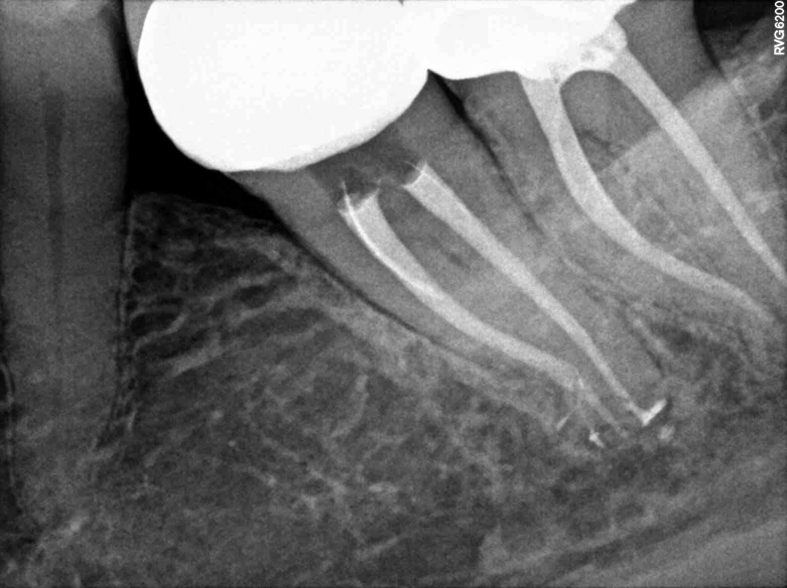 Deltas apicales Nina Camborda Endodoncista