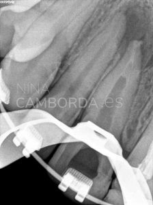 Barrera endodoncia de un 11 con barrera apical de Biodentine