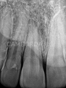 Diagnóstico endodoncia de un 11 con salida lateral en tercio medio radicular