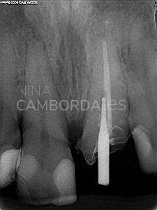 Diagnóstico endodoncia de un 11 con una reabsorción interna