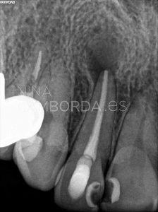 Diagnóstico endodoncia de un 12 con barrera apical de Biodentine