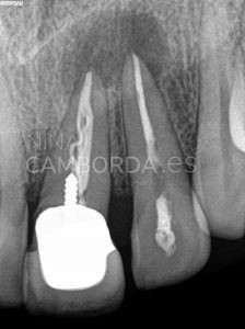 Diagnóstico endodoncia de un 21 con barrera apical de Biodentine
