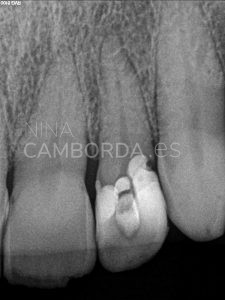 Diagnóstico endodoncia de un 22 con salida lateral en tercio medio radicular