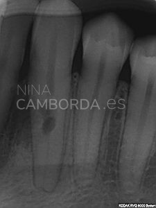 Diagnóstico endodoncia de un 33 con una reabsorción interna comunicante