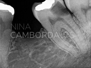Diagnóstico endodoncia de un 37 con bifurcación apical en la raíz distal