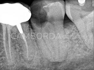 Diagnóstico endodoncia de un 37 que presenta deltas apicales