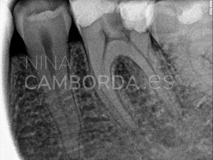 Diagnóstico endodoncia molar inferior 5 conductos