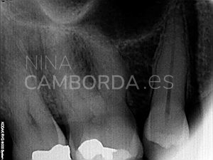 Diagnóstico molar superior 5 conductos