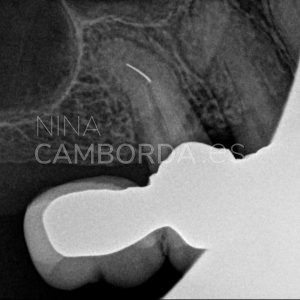 Diagnóstico reendodoncia de un 15 con un instrumento fracturado tras la curvatura radicular