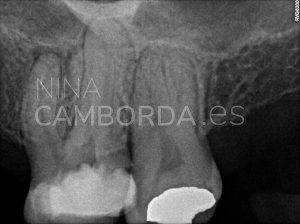 Diagnóstico reendodoncia de un 26 que presenta un instrumento fracturado en la raíz mesio-vestibular
