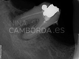 Diagnóstico reendodoncia molar inferior 5 conductos