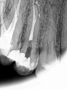 Final 2 endodoncia de un 15 con bifurcación en el tercio apical radicular