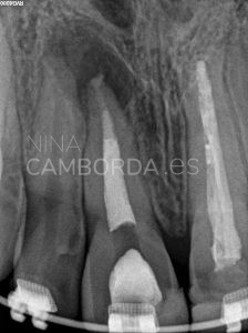 Final endodoncia de un 11 con barrera apical de Biodentine