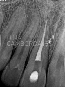 Final endodoncia de un 11 con salida lateral en tercio medio radicular