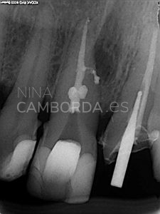 Final endodoncia de un 11 con una reabsorción interna