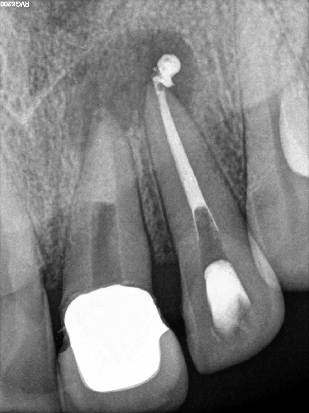 Barreras apicales con Biodentine Nina Camborda Endodoncista