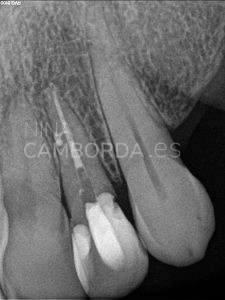 Final endodoncia de un 22 con salida lateral en tercio medio radicular