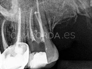 Final endodoncia de un 27 con salida lateral en tercio coronal de la raíz mesio-vestibular