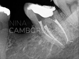 Final endodoncia de un 37 con bifurcación apical en la raíz distal