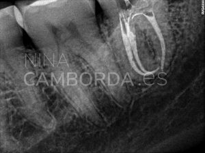 Final endodoncia de un cordal inferior con curvaturas apicales