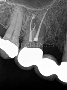 Final endodoncia de un 15 con lesión en furca y salida lateral hacia la misma